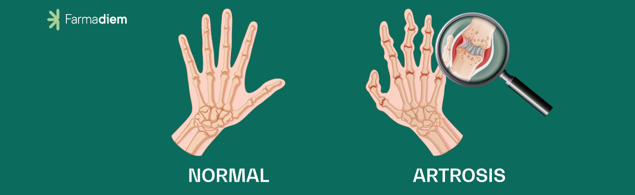 diferencias entre artrosis