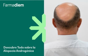 Alopecia androgénica: Características y Tratamiento